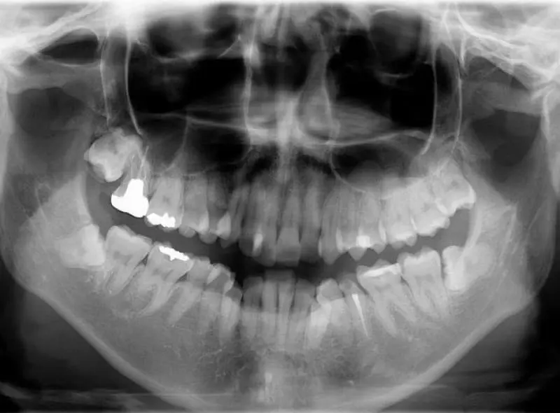 レントゲン写真